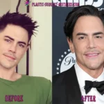 Tom Sandoval New Face – Botox, Lip Filleers