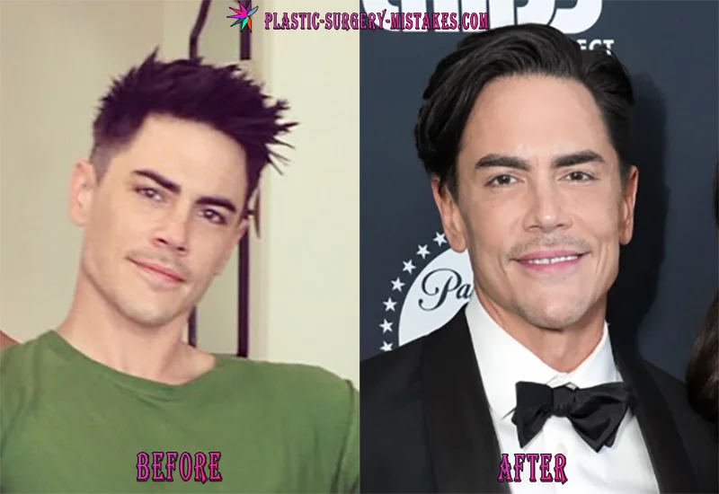 Tom Sandoval New Face - Botox, Lip Filleers Tom Sandoval New Face Botox Lip Filleers