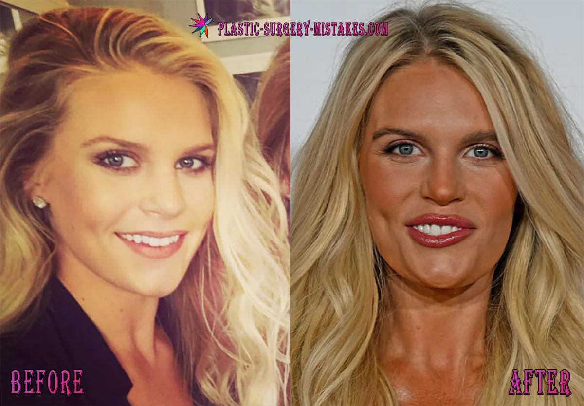 madison lecroy lip fillers and face transformation Madison Lecroy Lip Fillers And Face Transformation