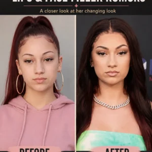 Bhad Bhabie Lips and Filler Rumors