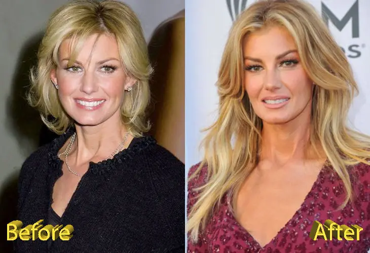 Faith Hill Before and After Cosmetic Surgery Faith Hill Before And After Cosmetic Surgery