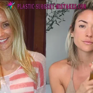 Kristin Cavallari Plastic Surgery