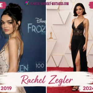 Rachel Zegler Plastic Surgery Before and After