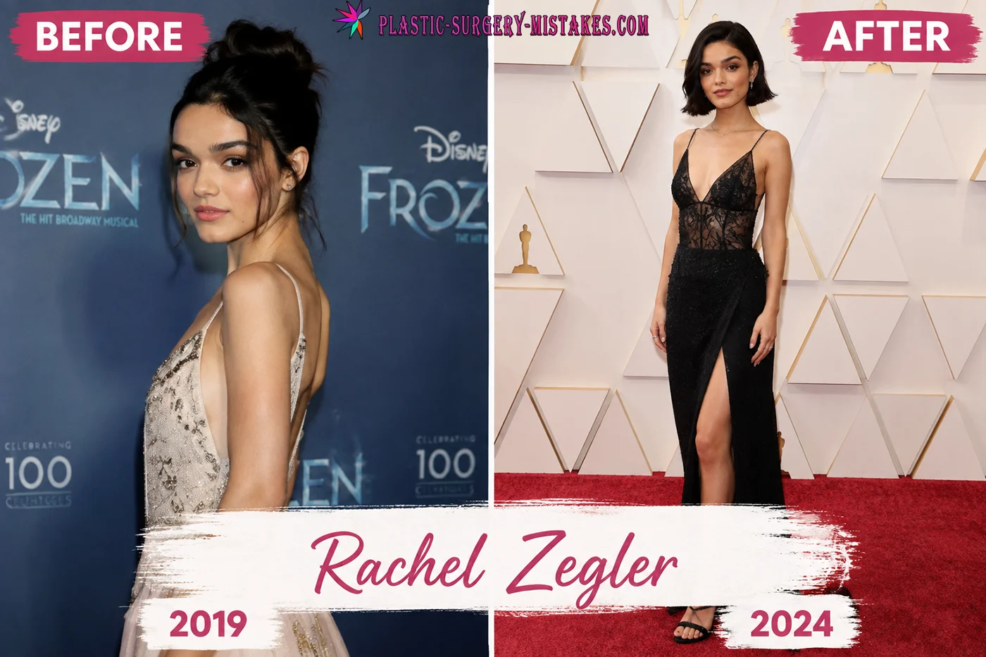 Rachel Zegler Plastic Surgery Before and After Rachel Zegler Plastic Surgery Before And After