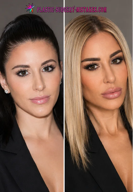 Shekinah plastic surgery before and after Shekinah Plastic Surgery Before And After