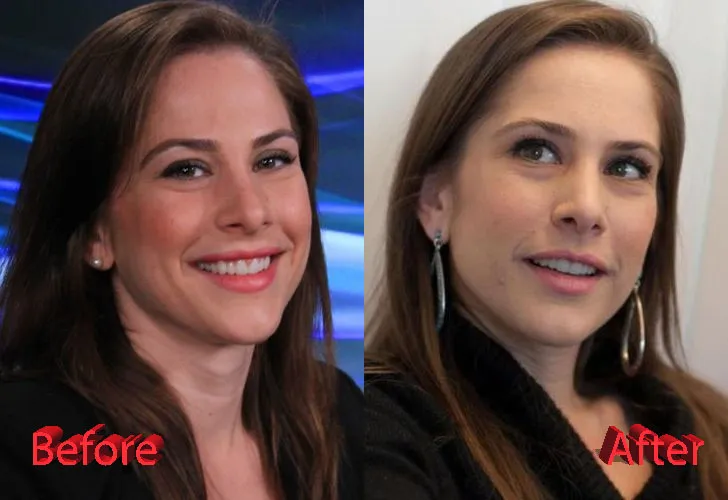 Ana Kasparian Nose Job: What She Admitted—and What’s Still Rumor
