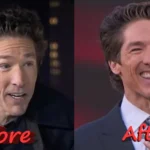 Joel Osteen Plastic Surgery: What Really Changed His Face?