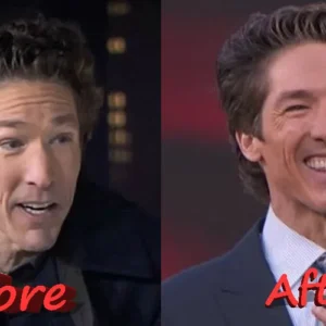 Joel Osteen Before and After Plastic Surgery
