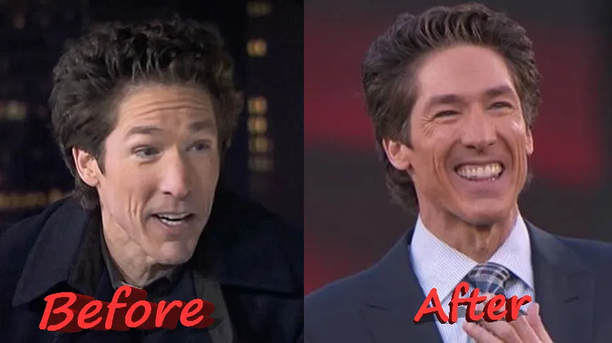 Joel Osteen Plastic Surgery: What Really Changed His Face?