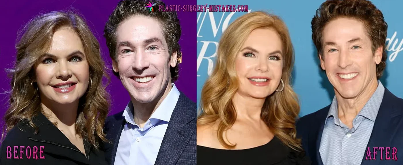Joel and Victorija Oesteen Before and After Plastic Surgeries Joel And Victorija Oesteen Before And After Plastic Surgeries